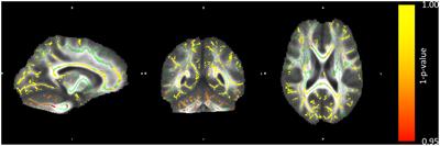 Reduced lateralization of the language network in the blind and its relationship with white matter tract neuroanatomy